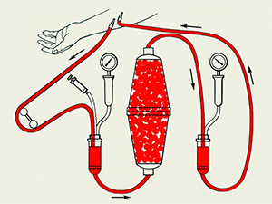 Схема проведения очистки крови методом гемосорбции