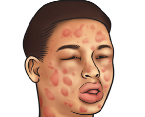 рисунок аллергической реакции на лице