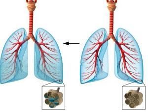 как выглядит отёк лёгких