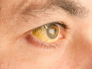 желтушность склер глаз