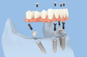 Что нужно знать о зубных имплантатах
